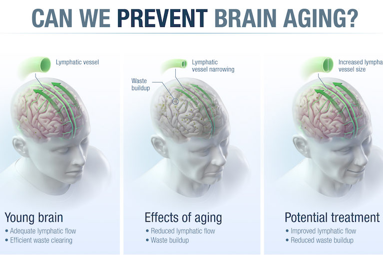 By fixing aging vessels surrounding the brain, we may be able to prevent Alzheimer's disease, age-related memory loss and other neurological problems.