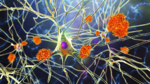 Nerve cells affected by Alzheimer's.