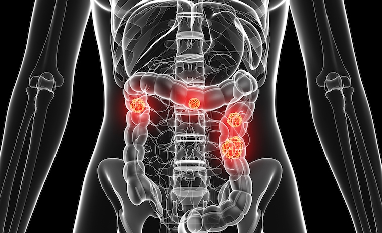 Colon cancer is depicted in a computer rendering.