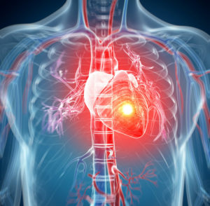 A heart glows red in an illustration of a heart attack.