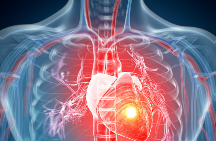 A heart glows red in an illustration of a heart attack.