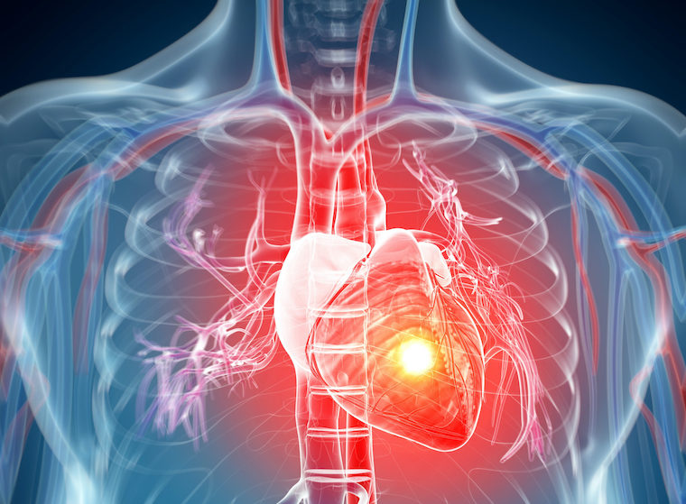 A heart glows red in an illustration of a heart attack.