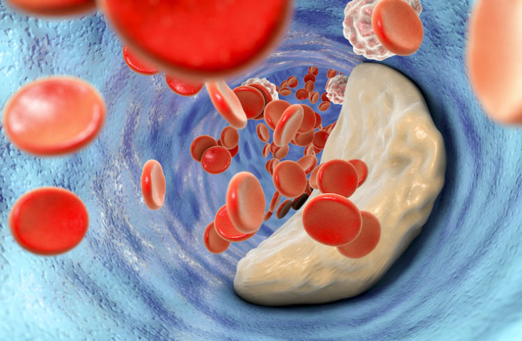 Red blood cells hurtle toward an atherosclerotic plaque inside a blood vessel.