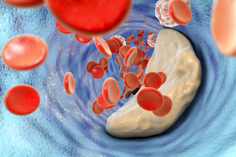 Red blood cells hurtle toward an atherosclerotic plaque inside a blood vessel.