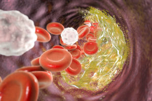 Red blood cells hurtle toward an atherosclerotic plaque in the blood vessels.