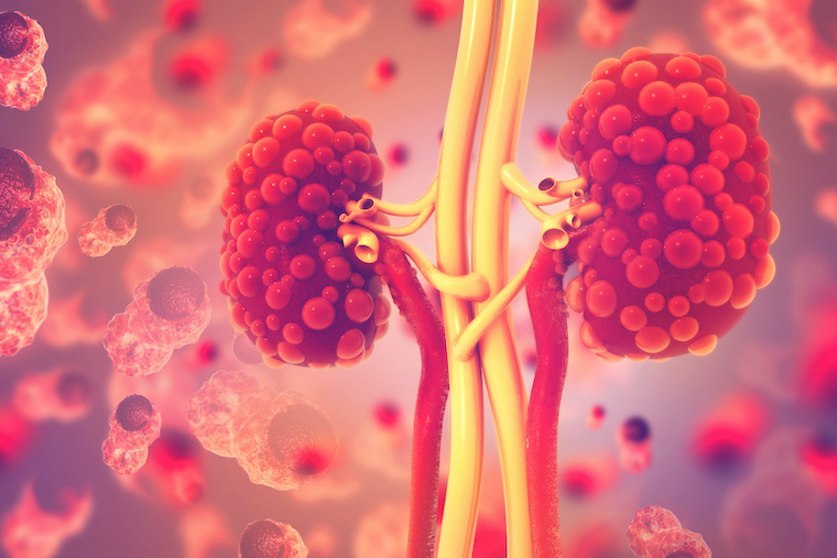 An image of polycystic kidney disease.