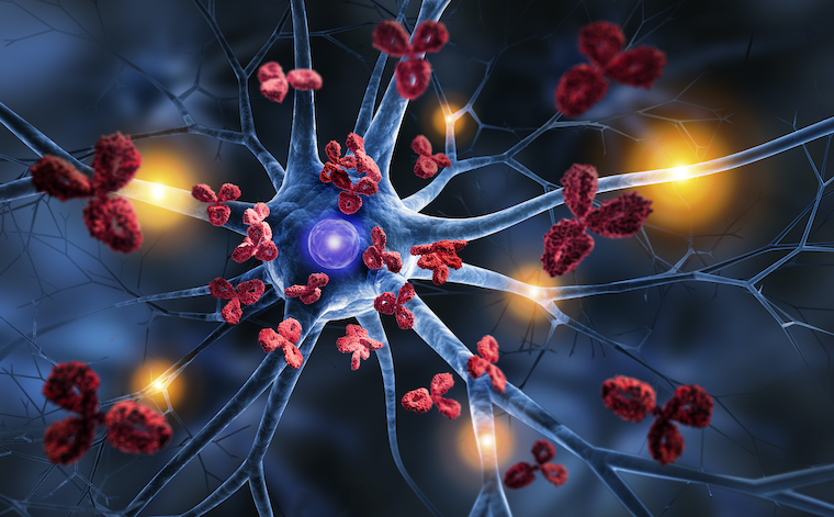 A nerve cell is attacked by antibodies in multiple sclerosis.