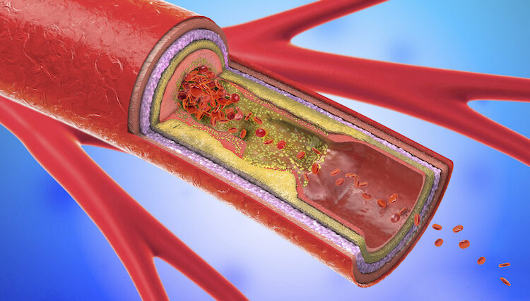 Clogged artery