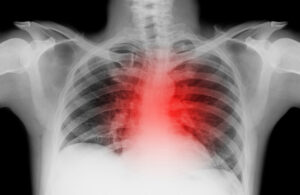 X ray of heart