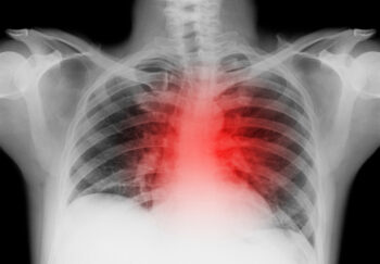 X ray of heart