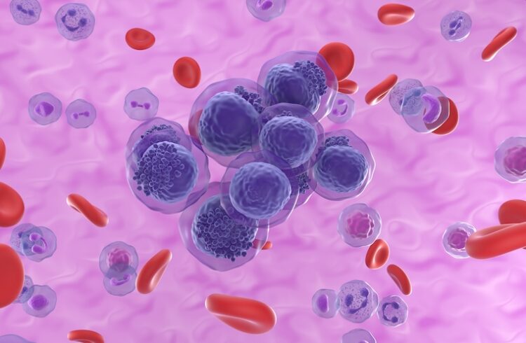 Illustration of acute myeloid leukemia
