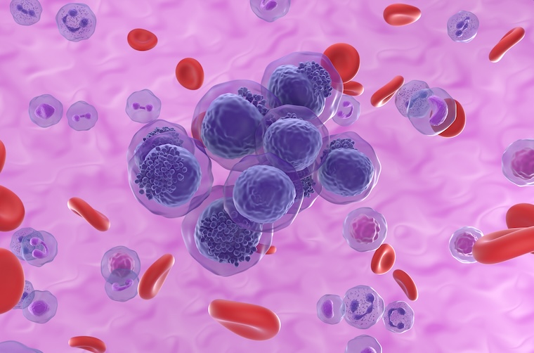 Illustration of acute myeloid leukemia