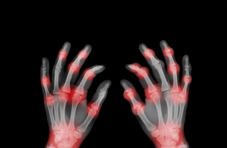 X ray of painful hands