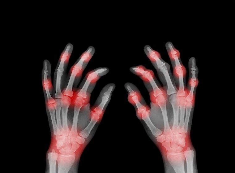 X ray of painful hands