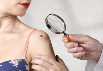 Doctor looks at melanoma