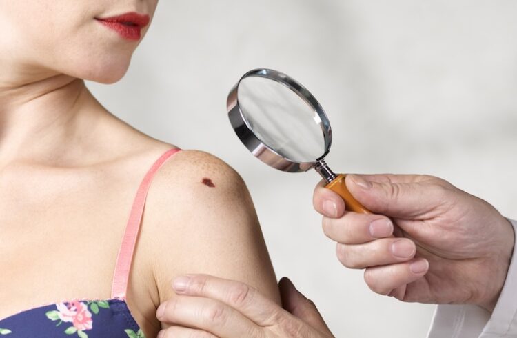 Doctor looks at melanoma