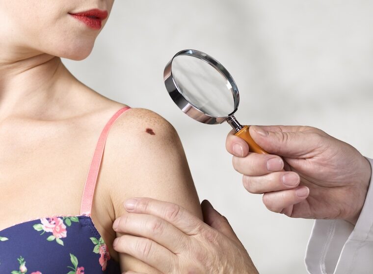 Doctor looks at melanoma