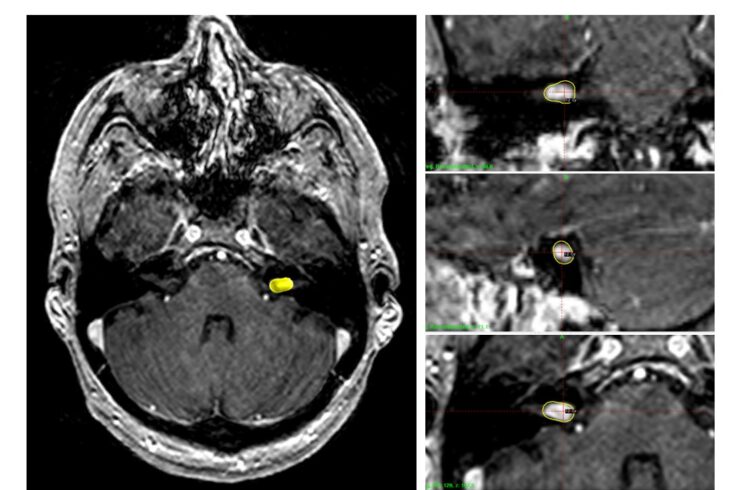 Brain scan showing a vestibular schwannoma