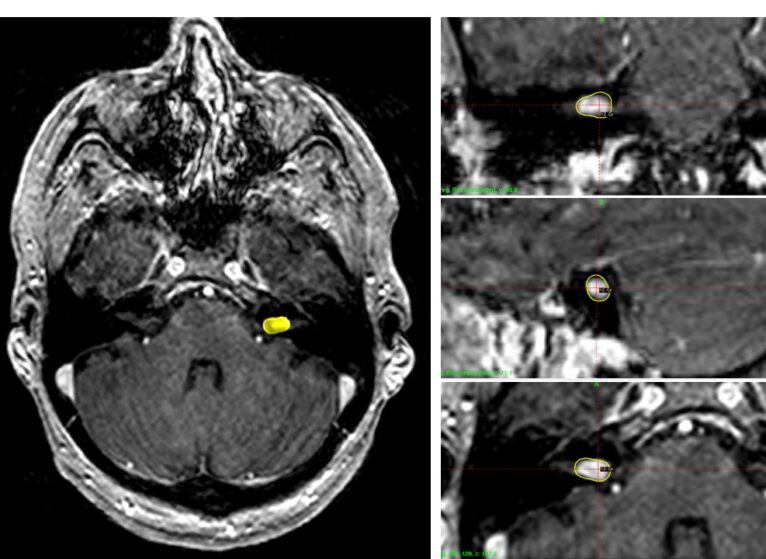 Brain scan showing a vestibular schwannoma