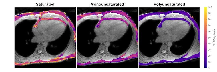 MRI heart images created by UVA's new technique