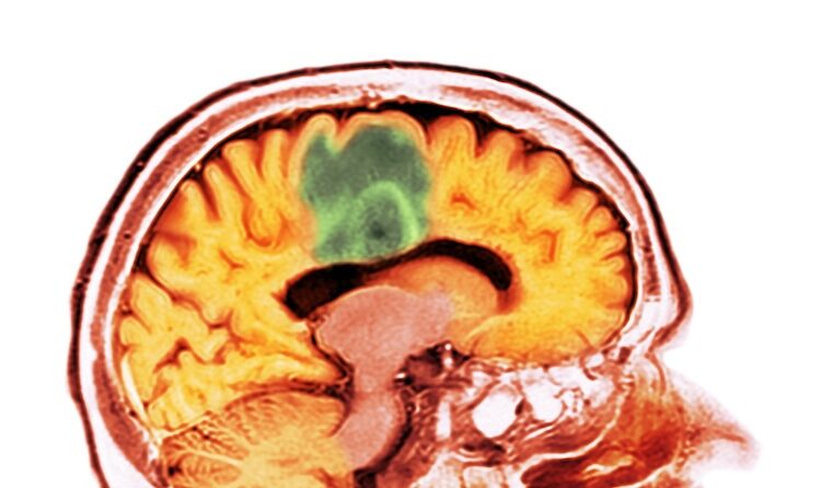 Brain scan showing glioblastoma tumor