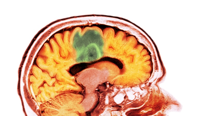 Brain scan showing glioblastoma tumor